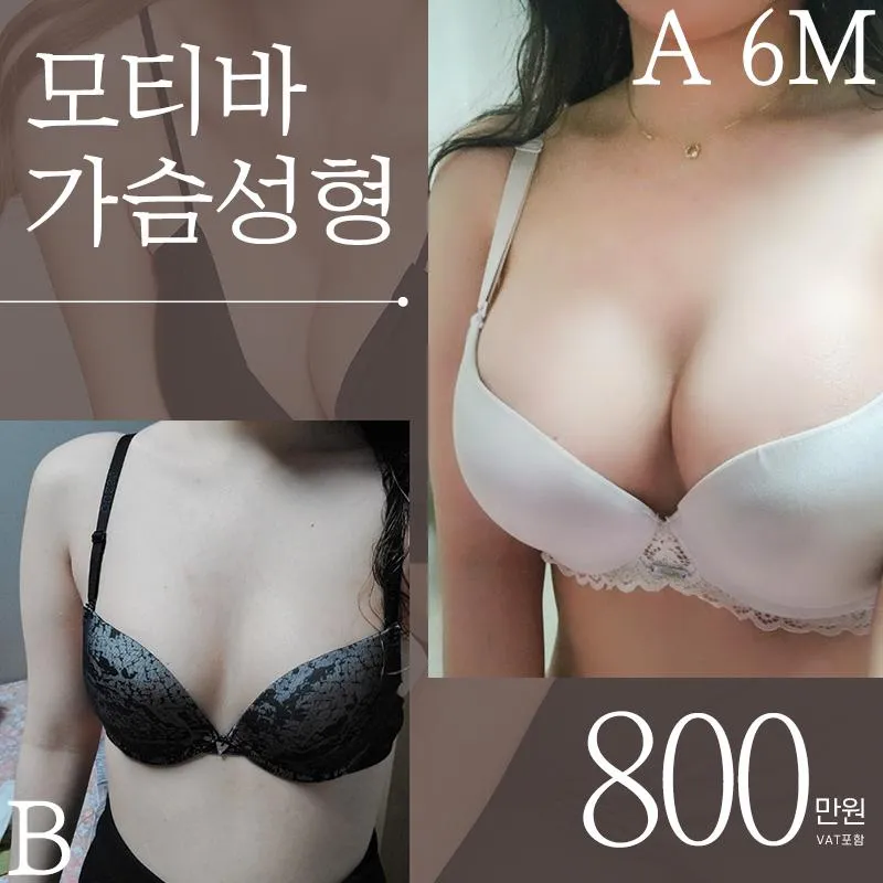 모티바♡프리티가슴성형 이벤트 썸네일 이미지