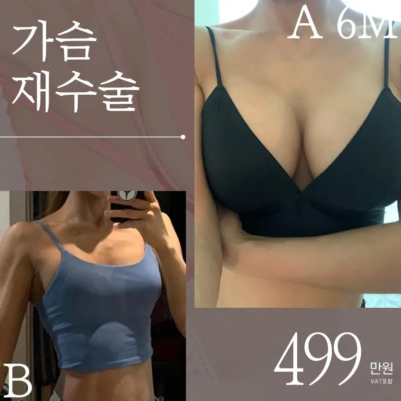 ♥프리티 가슴재수술♥ 이벤트 썸네일 이미지