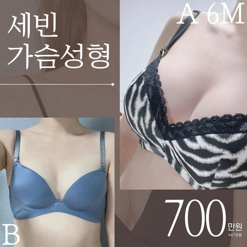 세빈인테그리티♥가슴성형 이벤트 썸네일 이미지