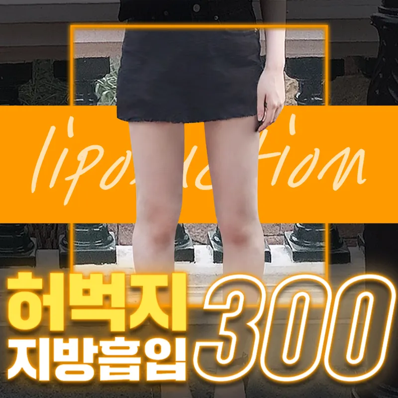 [서울/청담] 허벅지흡 말해뭐해⁉ 이벤트 썸네일 이미지