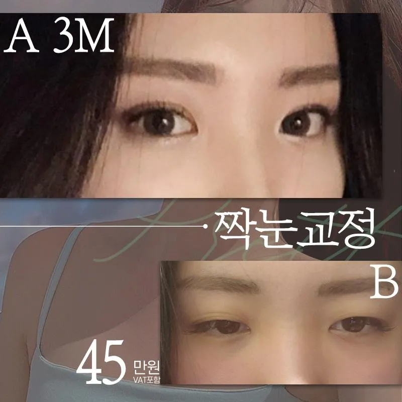 ♥프리티 짝눈교정♥ 이벤트 썸네일 이미지