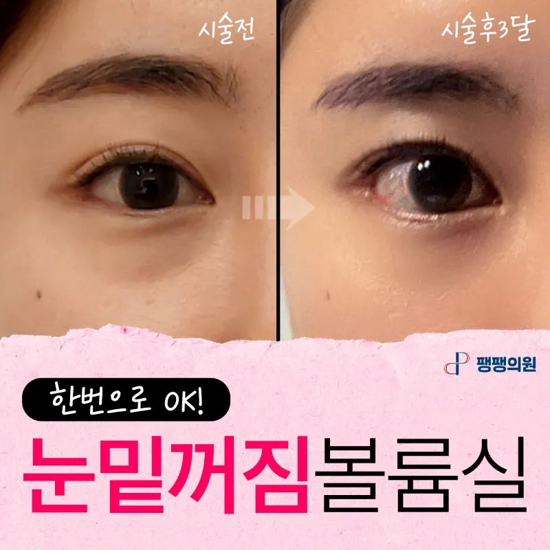 눈밑볼륨👀 채우는 실리프팅 이벤트 썸네일 이미지