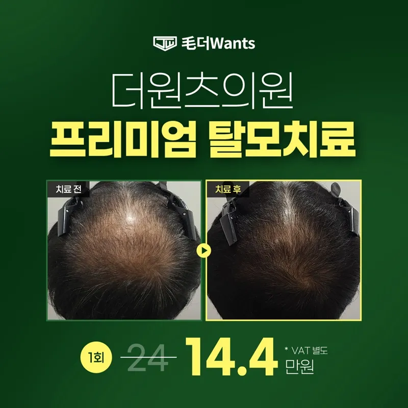 프리미엄 탈모치료♥ 이벤트 썸네일 이미지