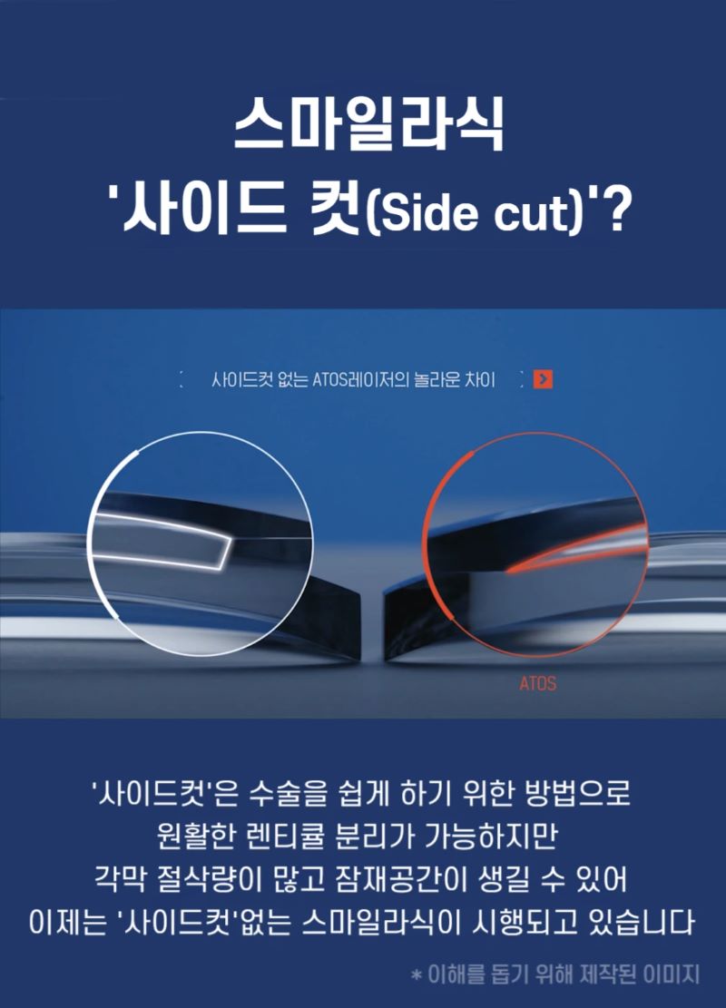 강남이오스안과의원 사이드컷 없는 스마일라식  이벤트, 시술 상세 이미지