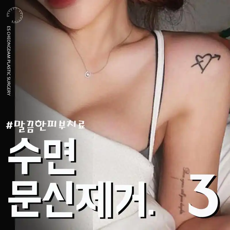 아프지마 수면문신제거