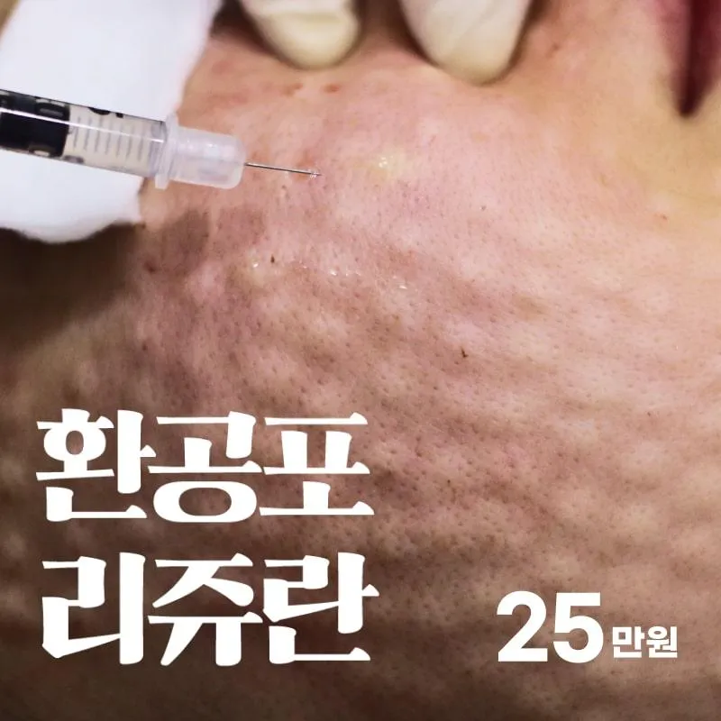환공포리쥬란 2cc+피부진단+진정관리 이벤트 썸네일 이미지