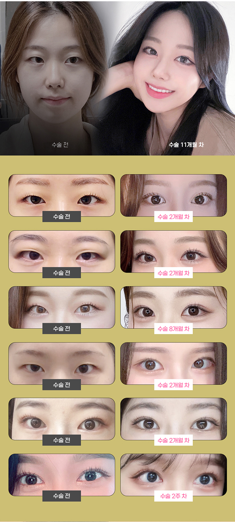 하이봄성형외과의원 하이봄 트임성형(뒤트임) 이벤트, 시술 상세 이미지