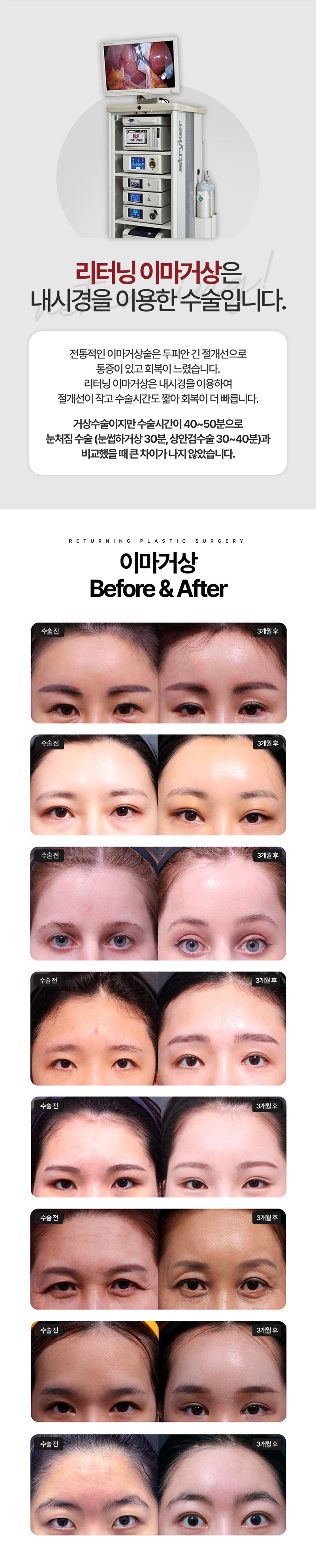 리터닝성형외과 리터닝 이마거상 이벤트, 시술 상세 이미지