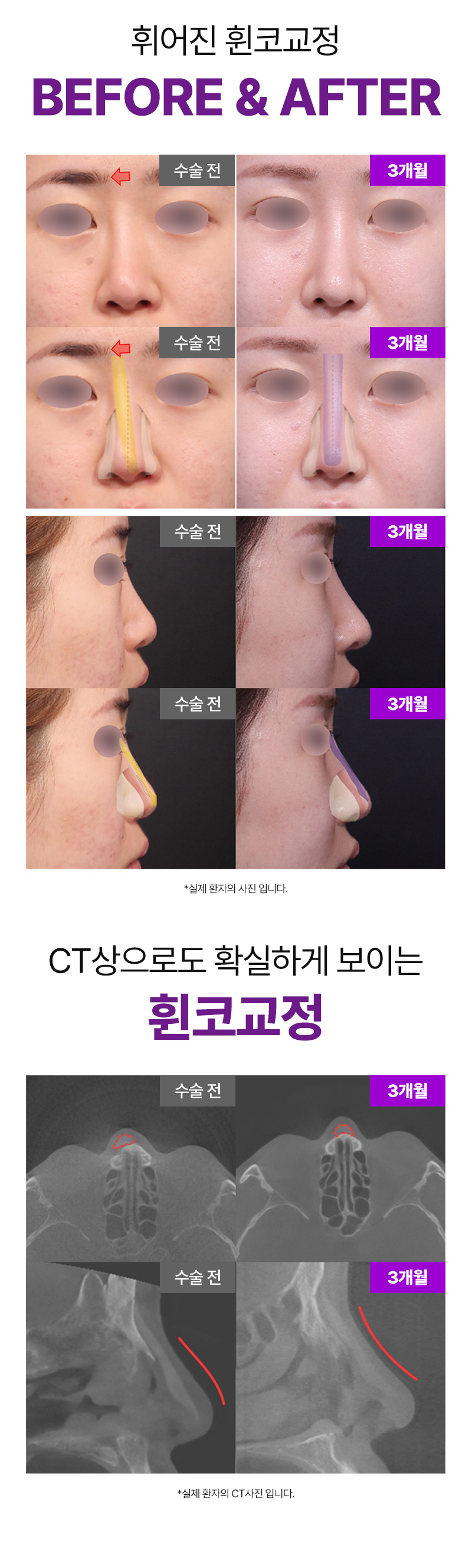 리터닝성형외과 리터닝3D핏미코맞춤보형물 이벤트, 시술 상세 이미지