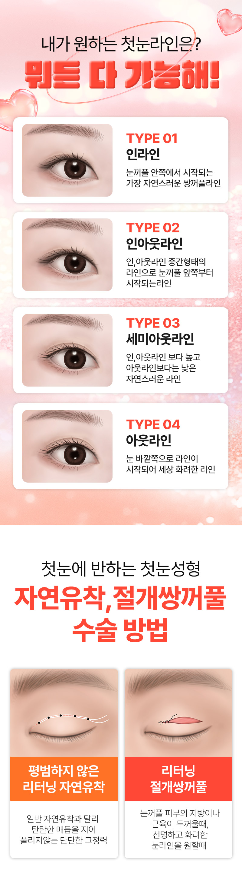 리터닝성형외과 리터닝 첫눈성형 이벤트, 시술 상세 이미지