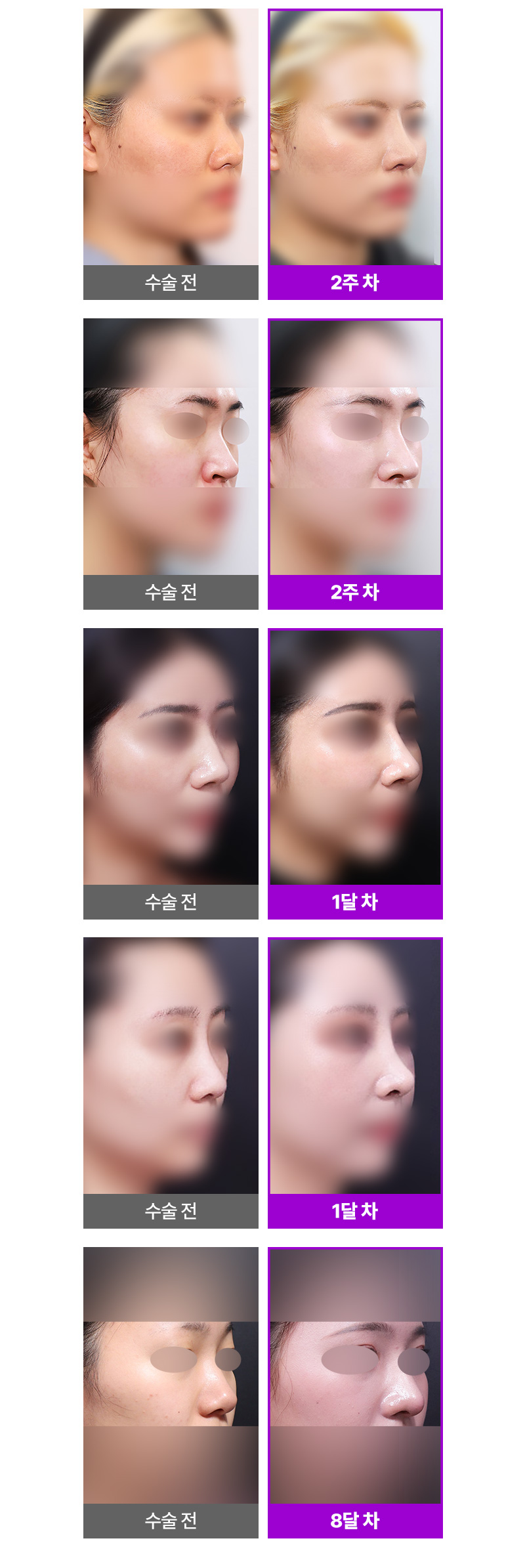 리터닝성형외과 리터닝3D핏미코맞춤보형물 이벤트, 시술 상세 이미지