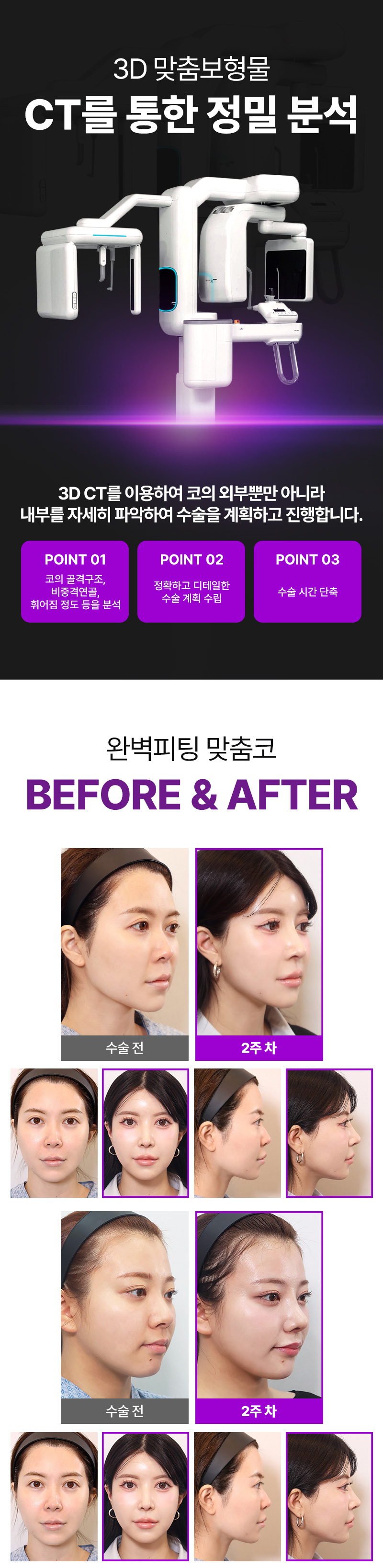리터닝성형외과 리터닝3D핏미코맞춤보형물 이벤트, 시술 상세 이미지