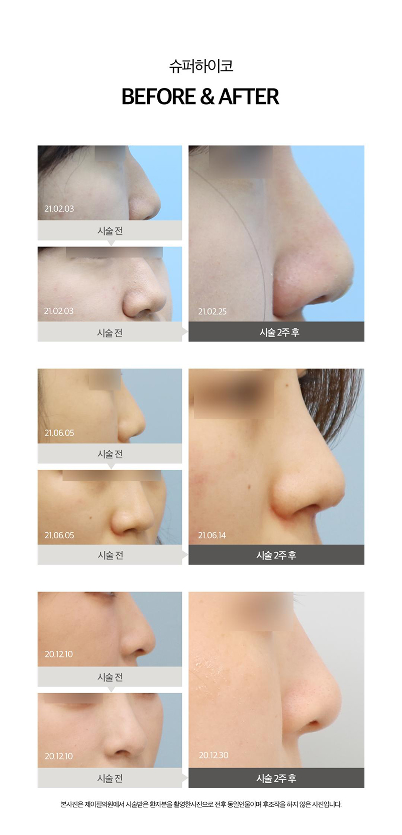 제이필의원 슈퍼하이코,필러로 코프팅, 콧대리프팅 이벤트, 시술 상세 이미지