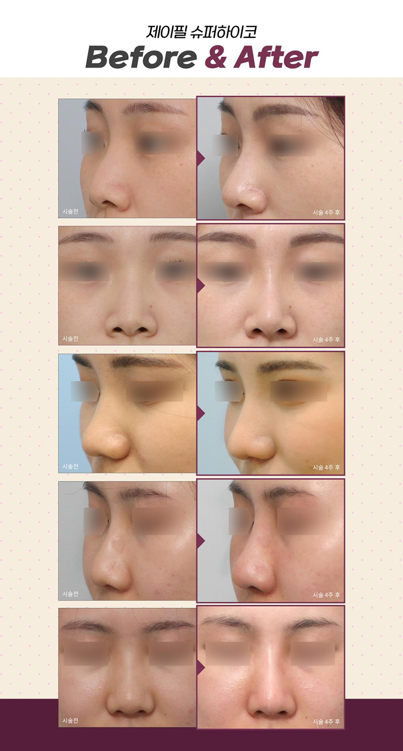 제이필의원 슈퍼하이코,필러로 코프팅, 콧대리프팅 이벤트, 시술 상세 이미지