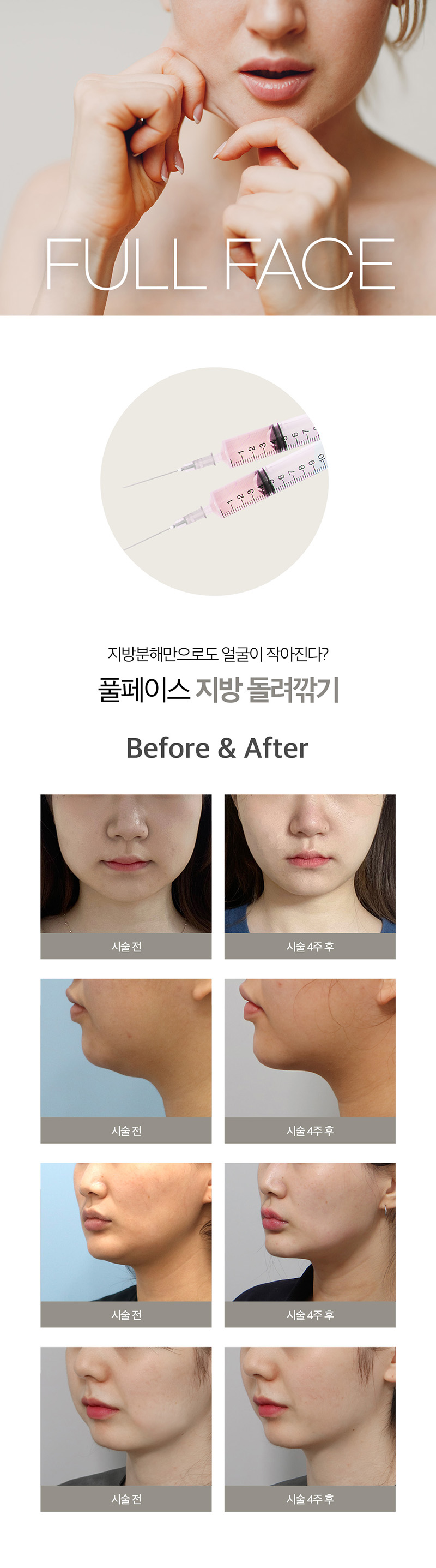제이필의원 제이필 풀페이스 윤곽 지방분해주사 이벤트, 시술 상세 이미지
