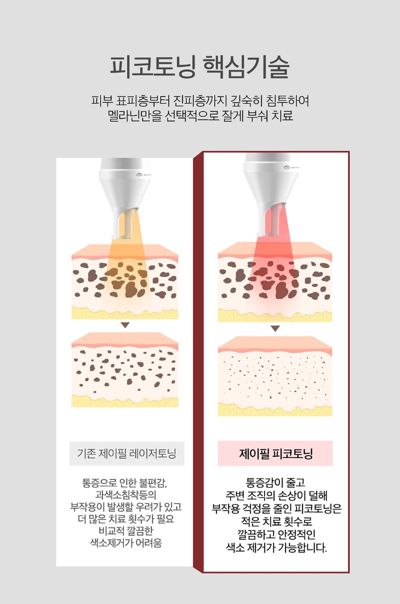 제이필의원 색소침착 치료엔 피코토닝 이벤트, 시술 상세 이미지