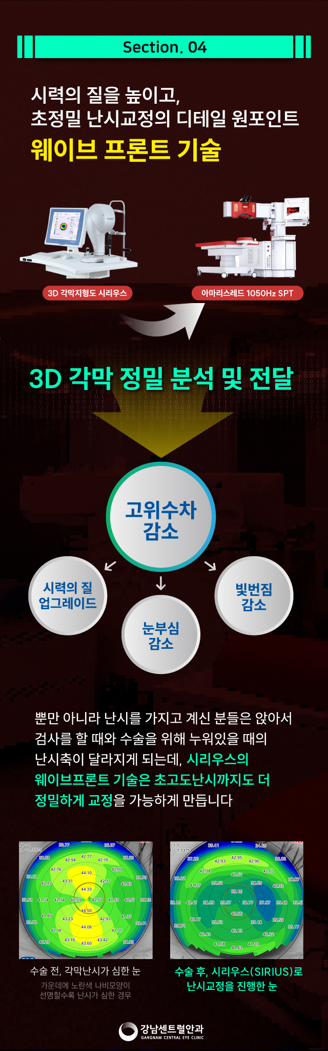 강남센트럴안과의원 1.5일 회복속도, 원포인트 라섹 이벤트, 시술 상세 이미지