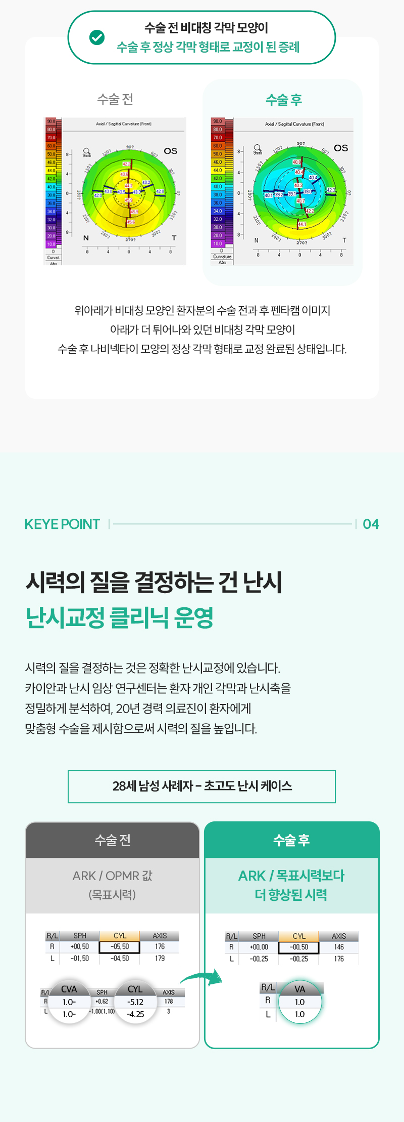 카이안과 개인 맞춤형 컨투라라식 특별할인 이벤트, 시술 상세 이미지