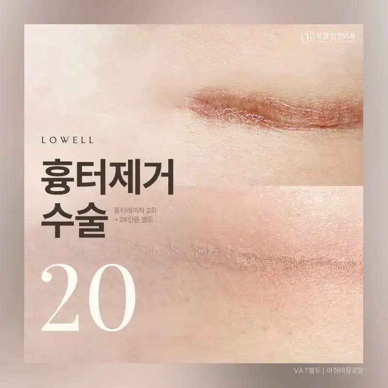 로웰_흉터제거수술