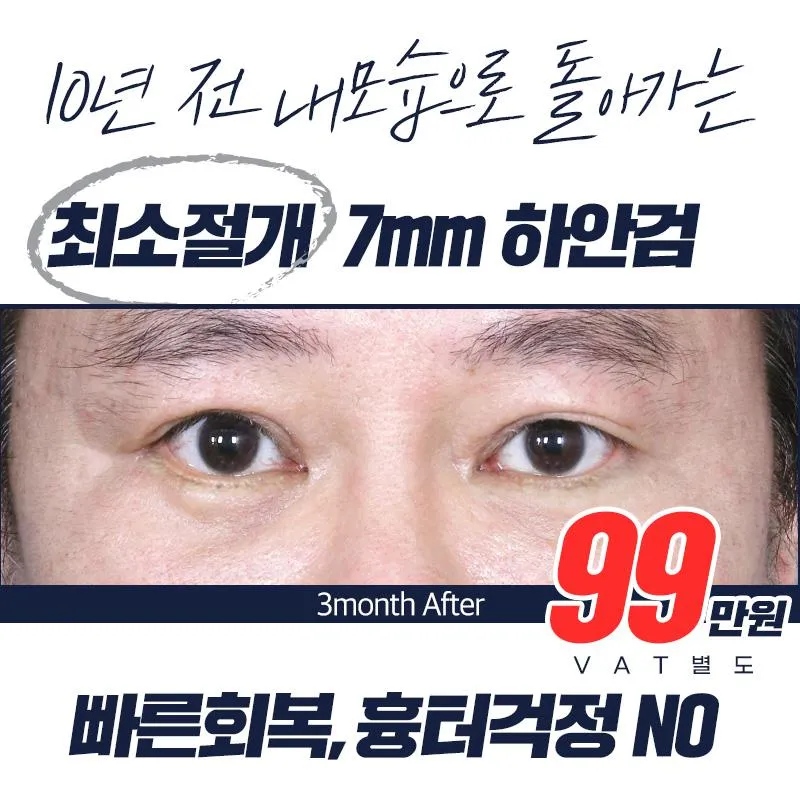 최소절개_7mm 하안검 이벤트 썸네일 이미지
