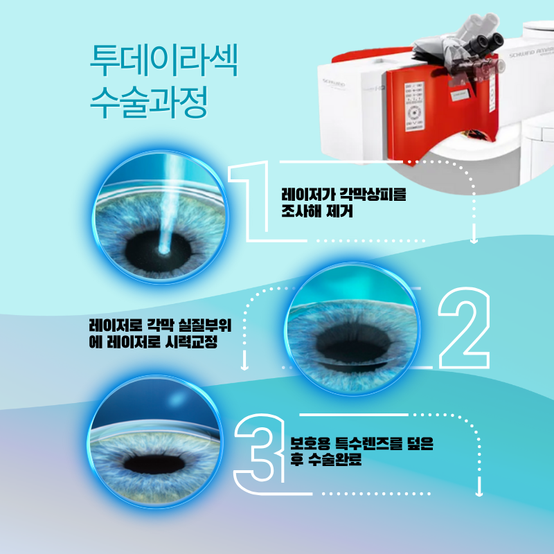 강남아이오케이안과 투데이라섹!!스마일라식!!할인이벤트 이벤트, 시술 상세 이미지