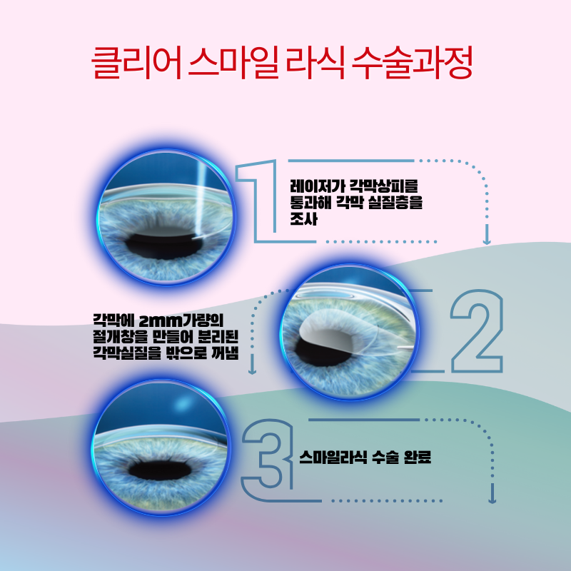 강남아이오케이안과 투데이라섹!!스마일라식!!할인이벤트 이벤트, 시술 상세 이미지
