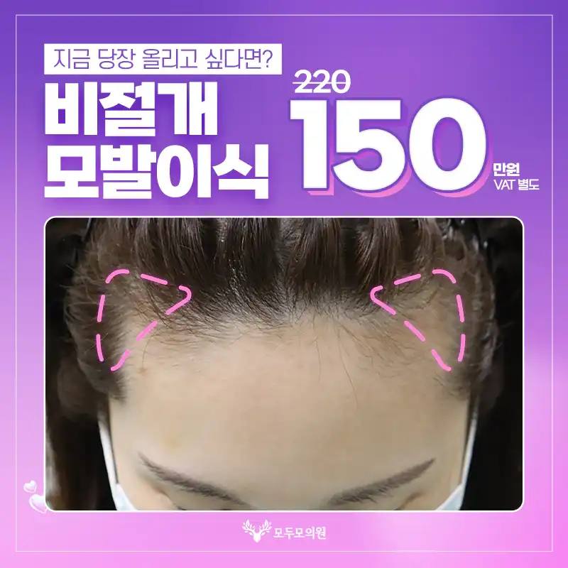 대구 비절개모발이식