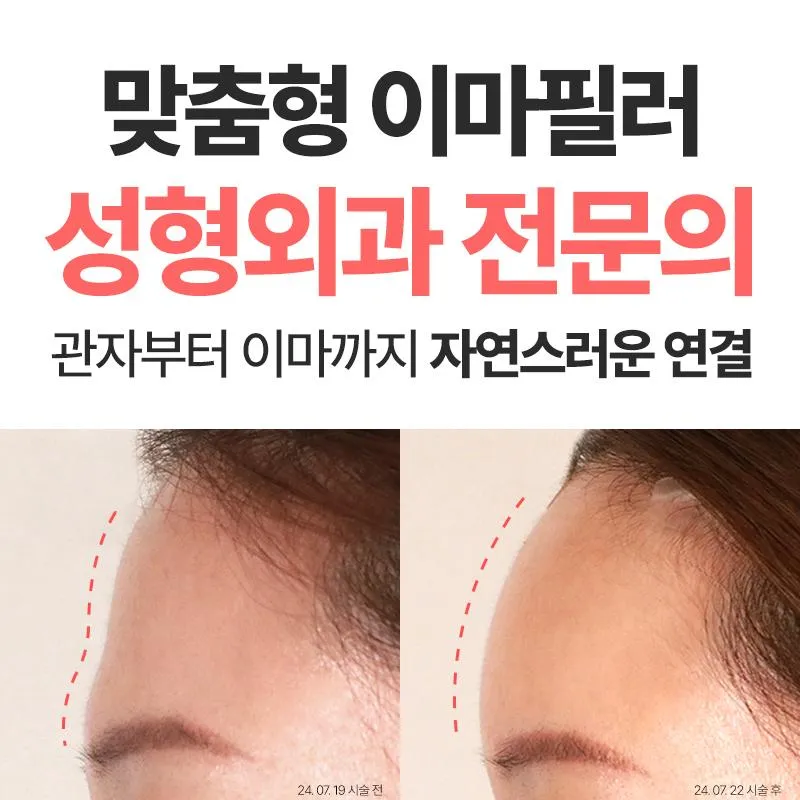 맞춤형 이마필러 4cc 이벤트 썸네일 이미지