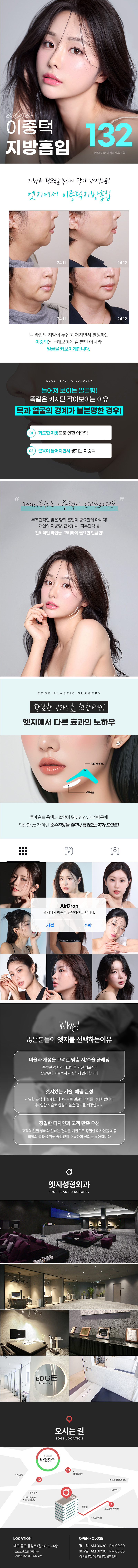 엣지성형외과 대구 엣지 이중턱 지방흡입 이벤트, 시술 상세 이미지