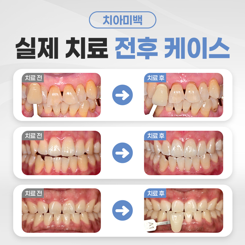 연세다감치과 다시 하얗게, 치아 미백 /당일 2회 이벤트, 시술 상세 이미지