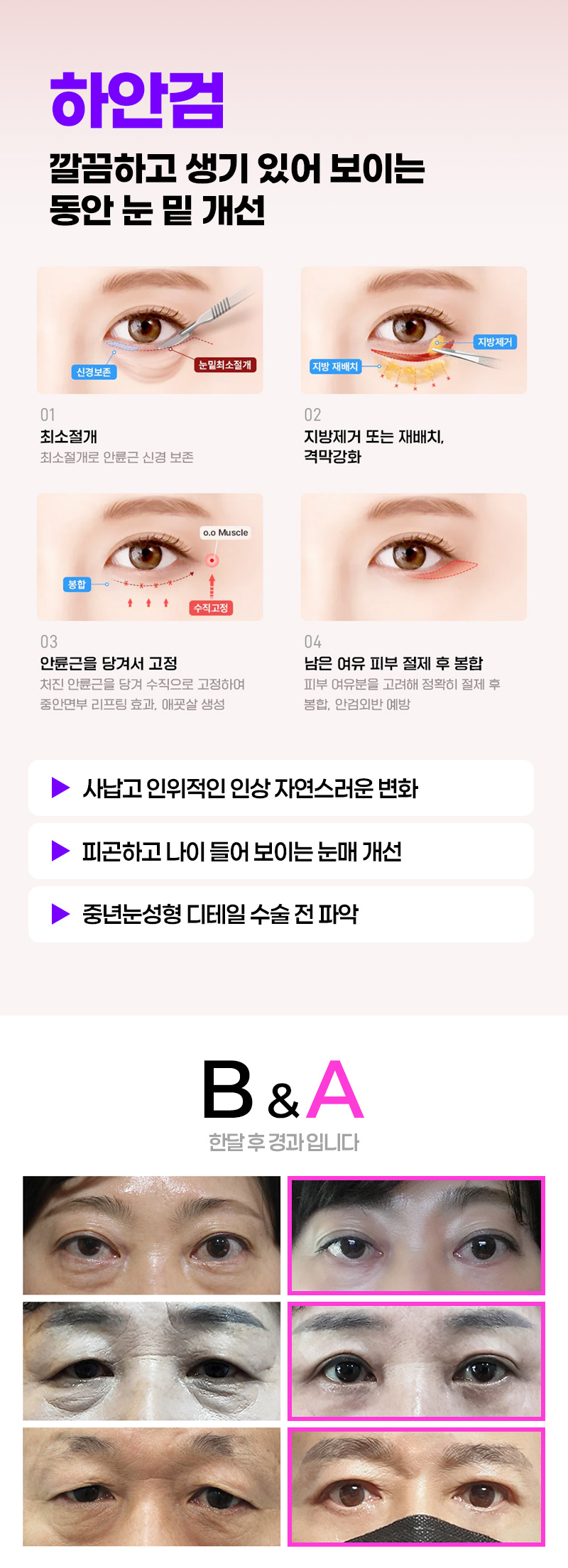 한나이브성형외과의원 [안양특집] 상,하안검 필요하신 분! 이벤트, 시술 상세 이미지