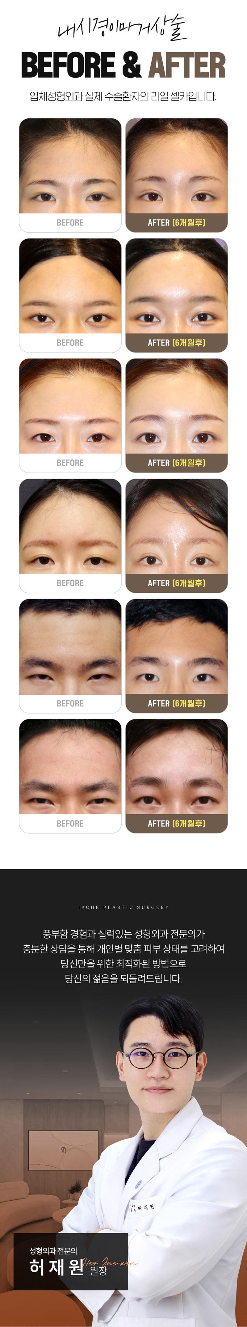 입체성형외과의원 입체 내시경 이마거상 이벤트, 시술 상세 이미지
