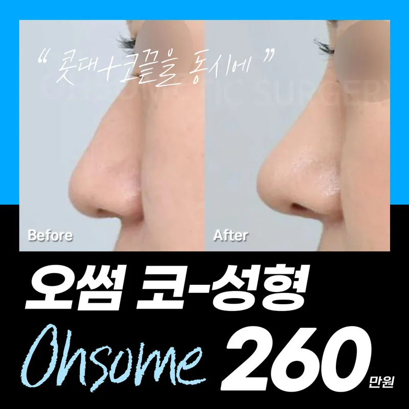오썸 비개방 콧대코끝성형 이벤트 썸네일 이미지