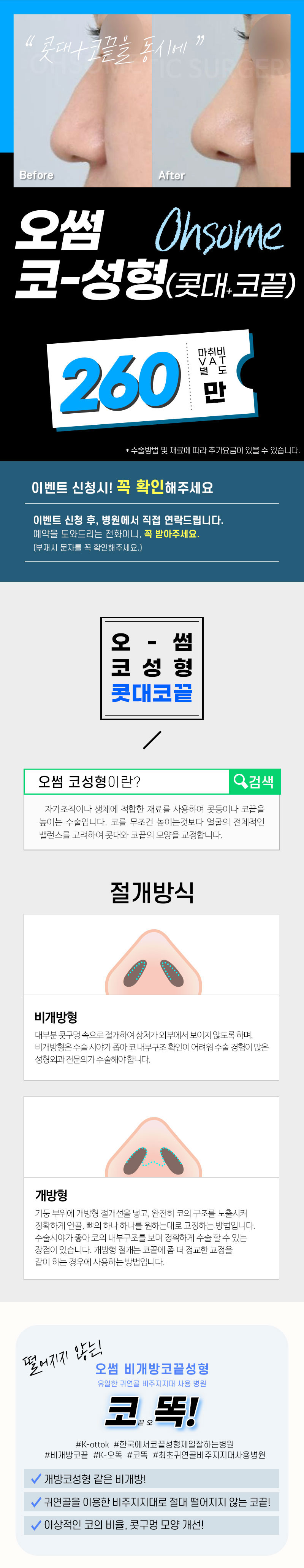 오썸성형외과 오썸 비개방 콧대코끝성형 이벤트, 시술 상세 이미지