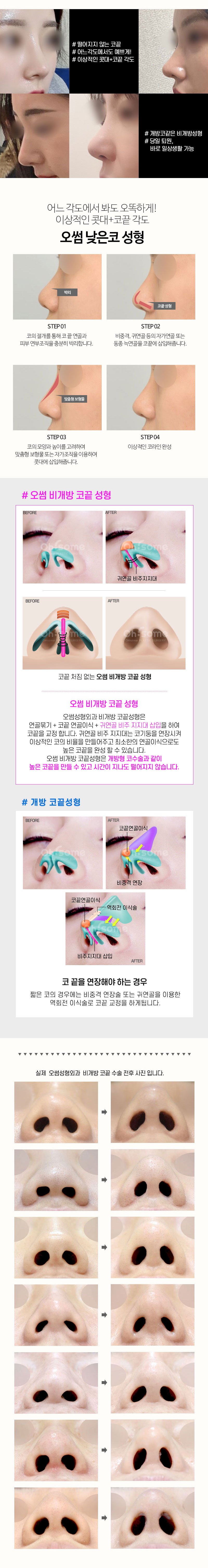 오썸성형외과 오썸 비개방 콧대코끝성형 이벤트, 시술 상세 이미지