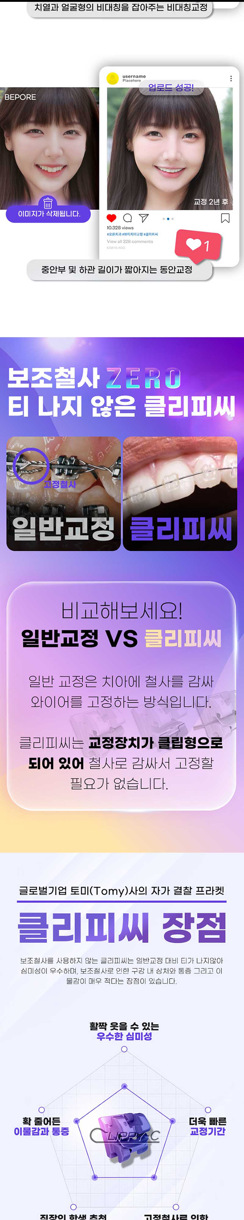 오른치과의원 비대칭잡는 동안뷰티 치아교정 클리피씨 이벤트, 시술 상세 이미지