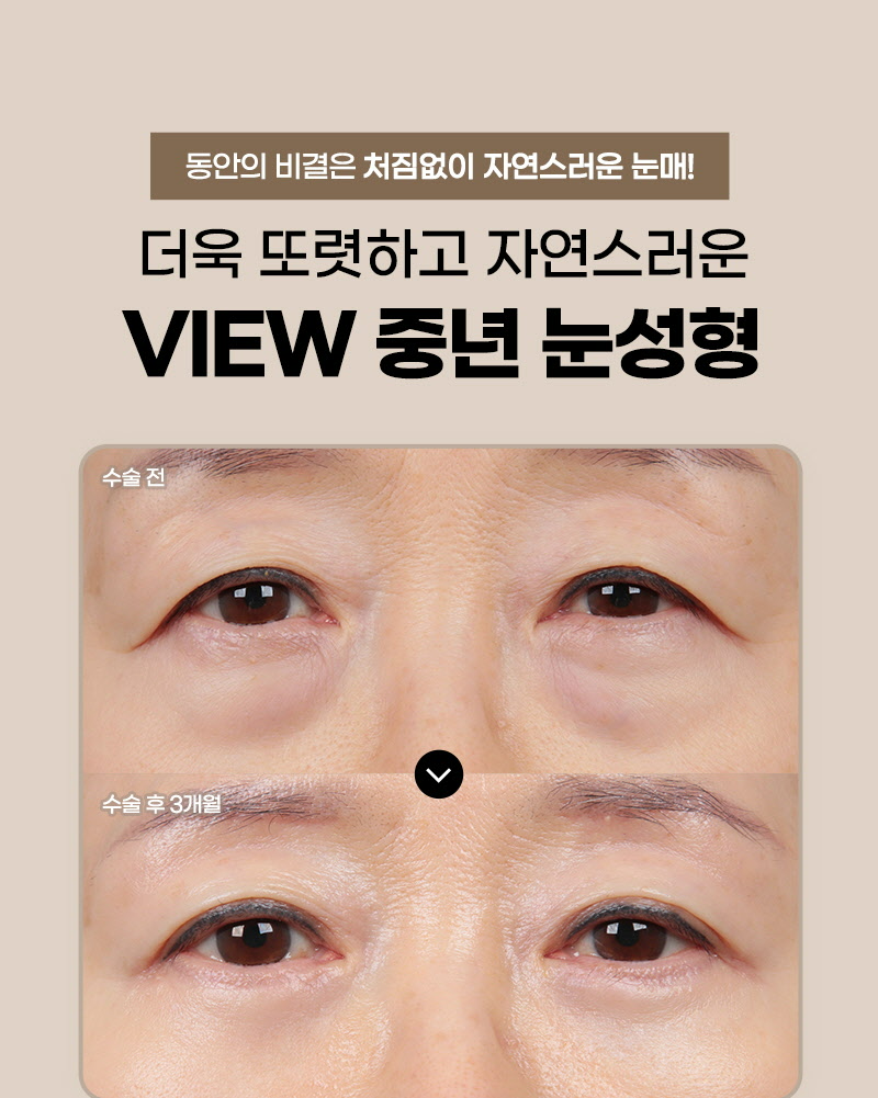 뷰성형외과 ❤️뷰❤️눈썹거상술 이벤트, 시술 상세 이미지