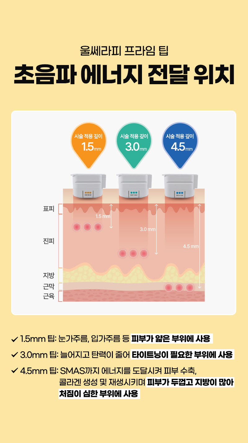 뷰성형외과 ❤뷰❤울쎄라피 프라임 이벤트, 시술 상세 이미지