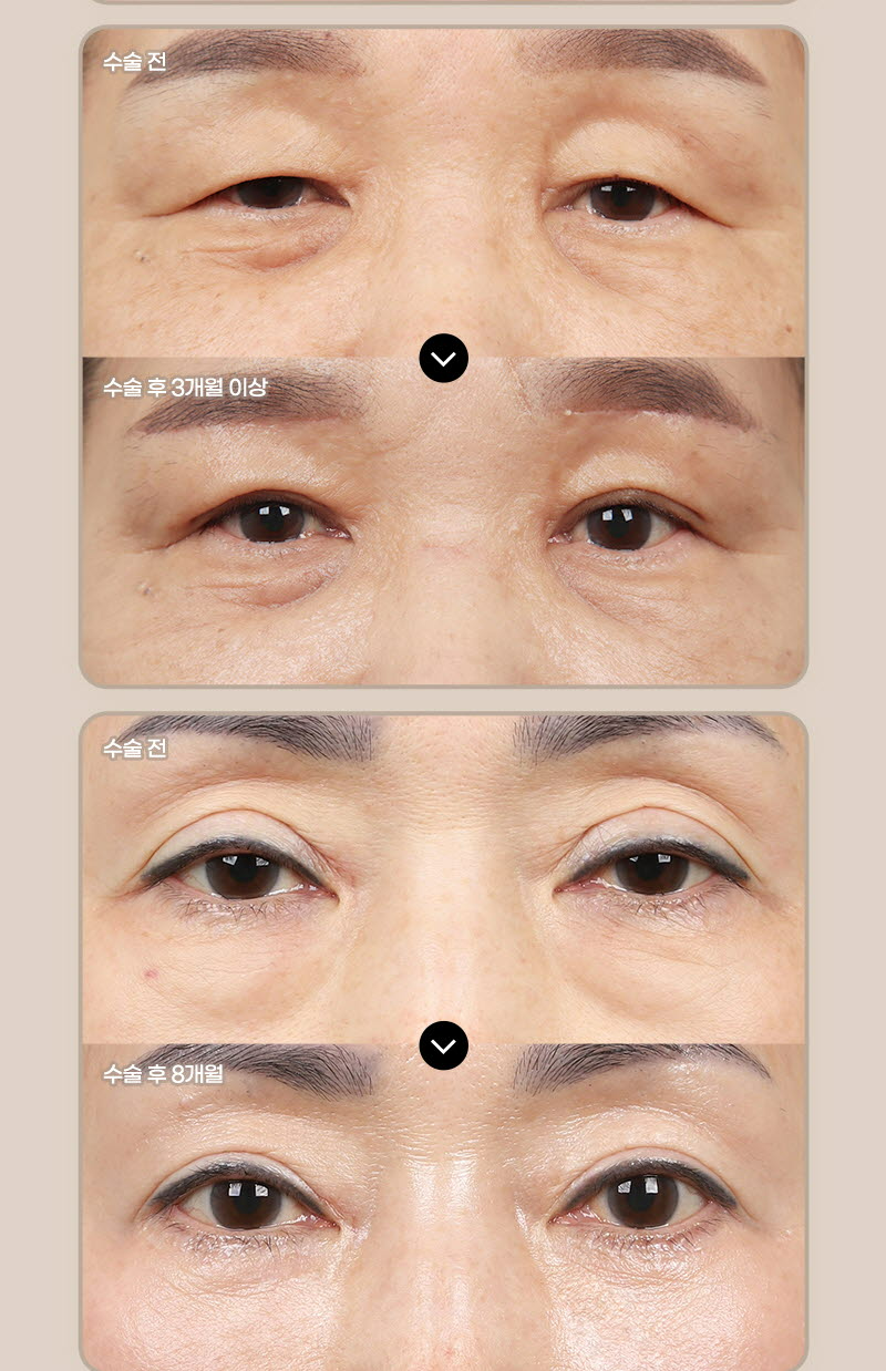 뷰성형외과 ❤️뷰❤️눈썹거상술 이벤트, 시술 상세 이미지