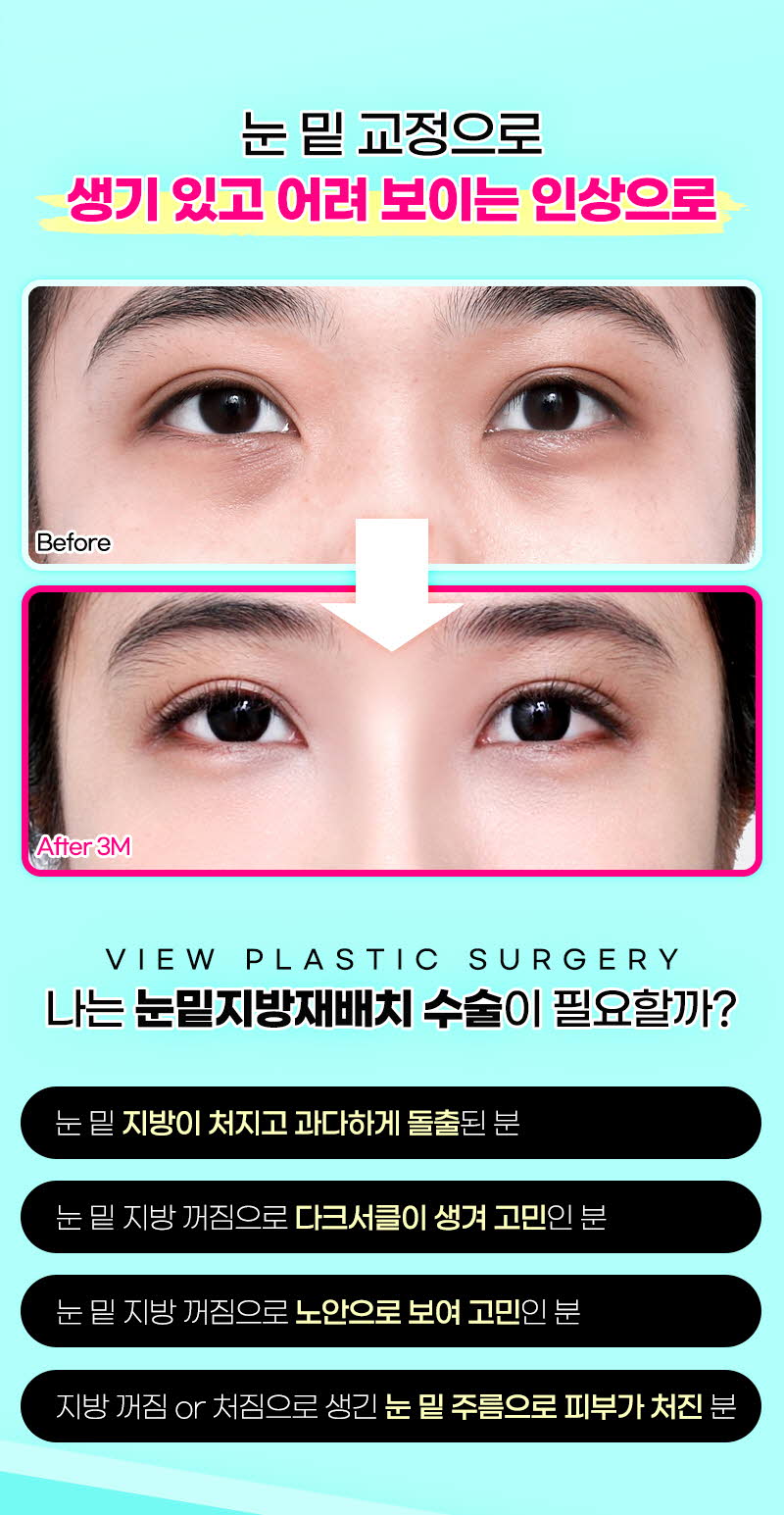 뷰성형외과 ❤️뷰❤️눈밑지방재배치 이벤트, 시술 상세 이미지