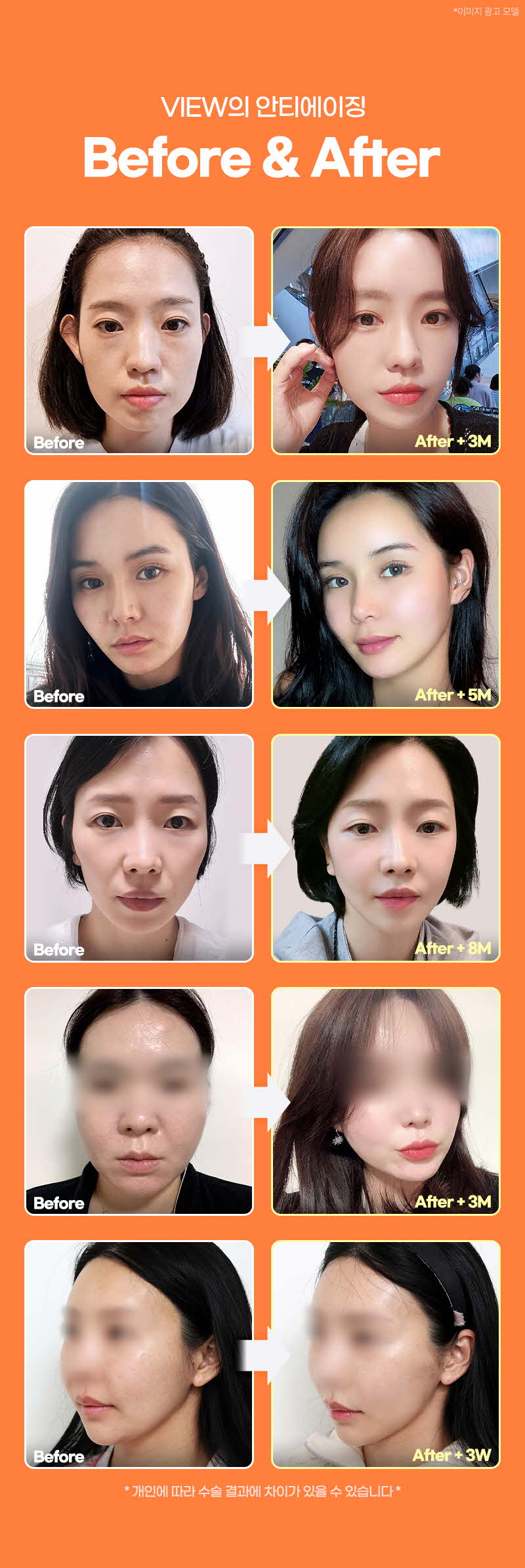 뷰성형외과 ❤뷰❤울쎄라피 프라임 이벤트, 시술 상세 이미지