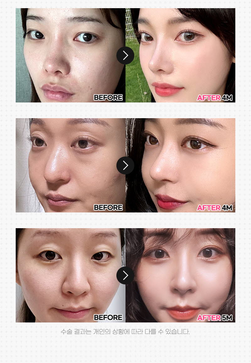 뷰성형외과 ❤️뷰❤️매부리코성형 이벤트, 시술 상세 이미지