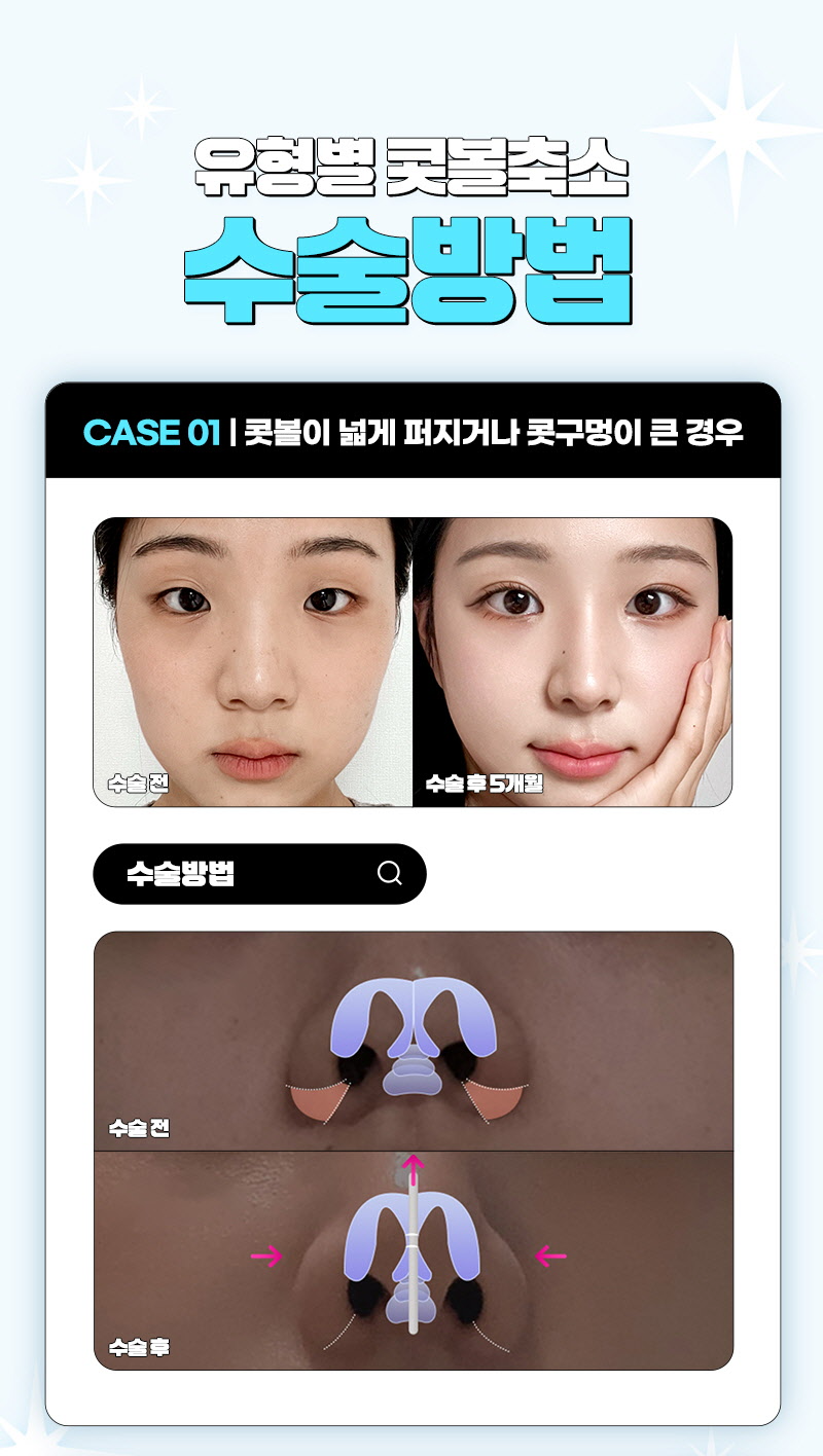 뷰성형외과 ❤️뷰❤️콧볼축소 이벤트, 시술 상세 이미지
