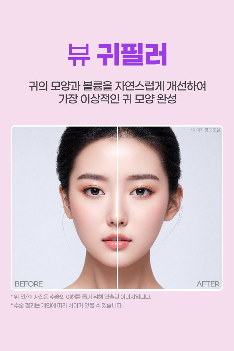뷰성형외과 ❤뷰❤귀필러 (수입정품) 이벤트, 시술 상세 이미지