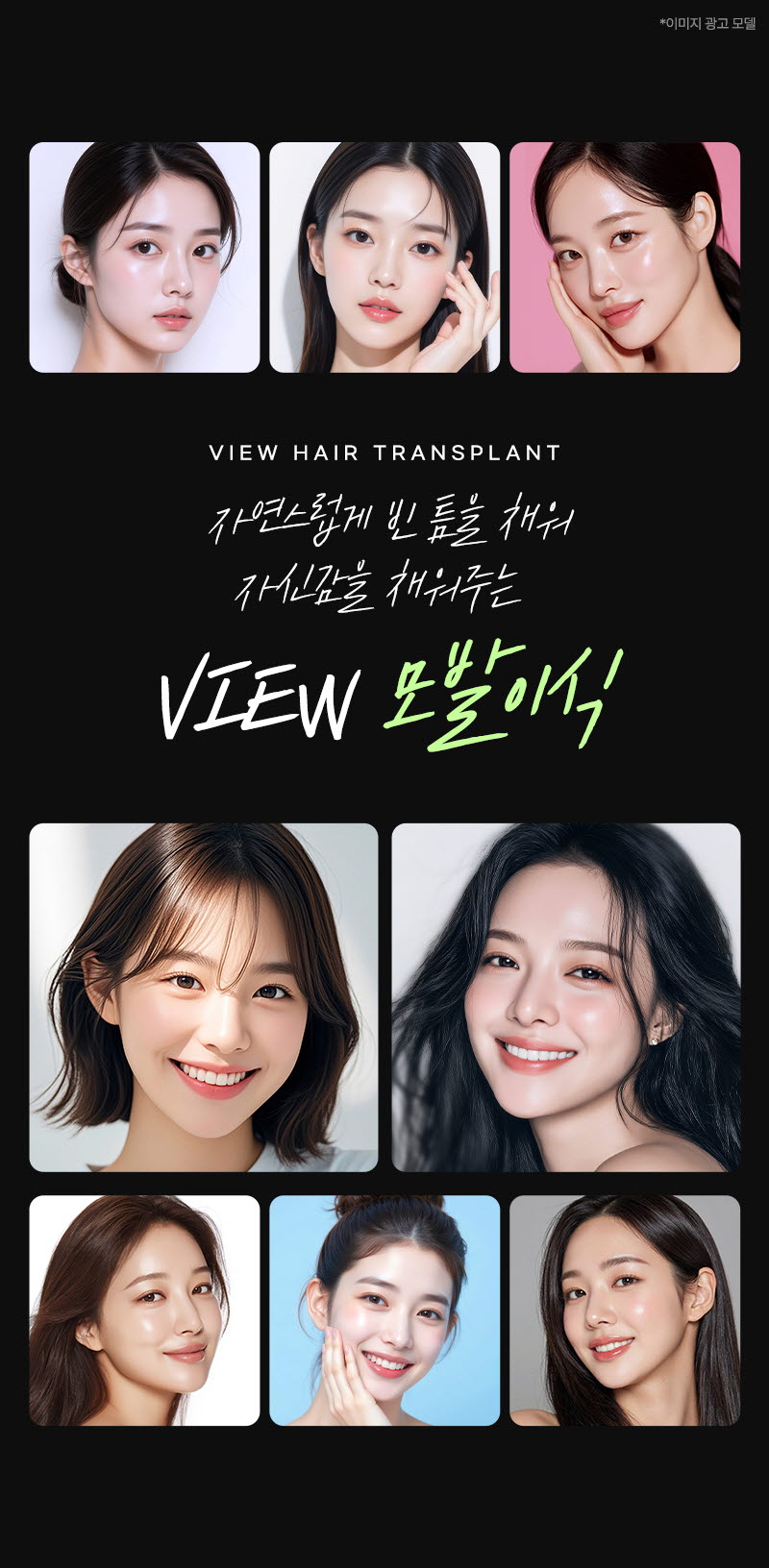 뷰성형외과 ❤뷰❤헤어라인 모발이식 이벤트, 시술 상세 이미지