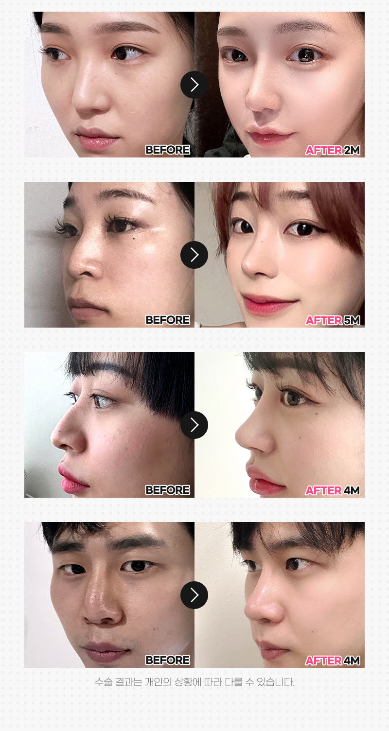 뷰성형외과 ❤️뷰❤️매부리코성형 이벤트, 시술 상세 이미지