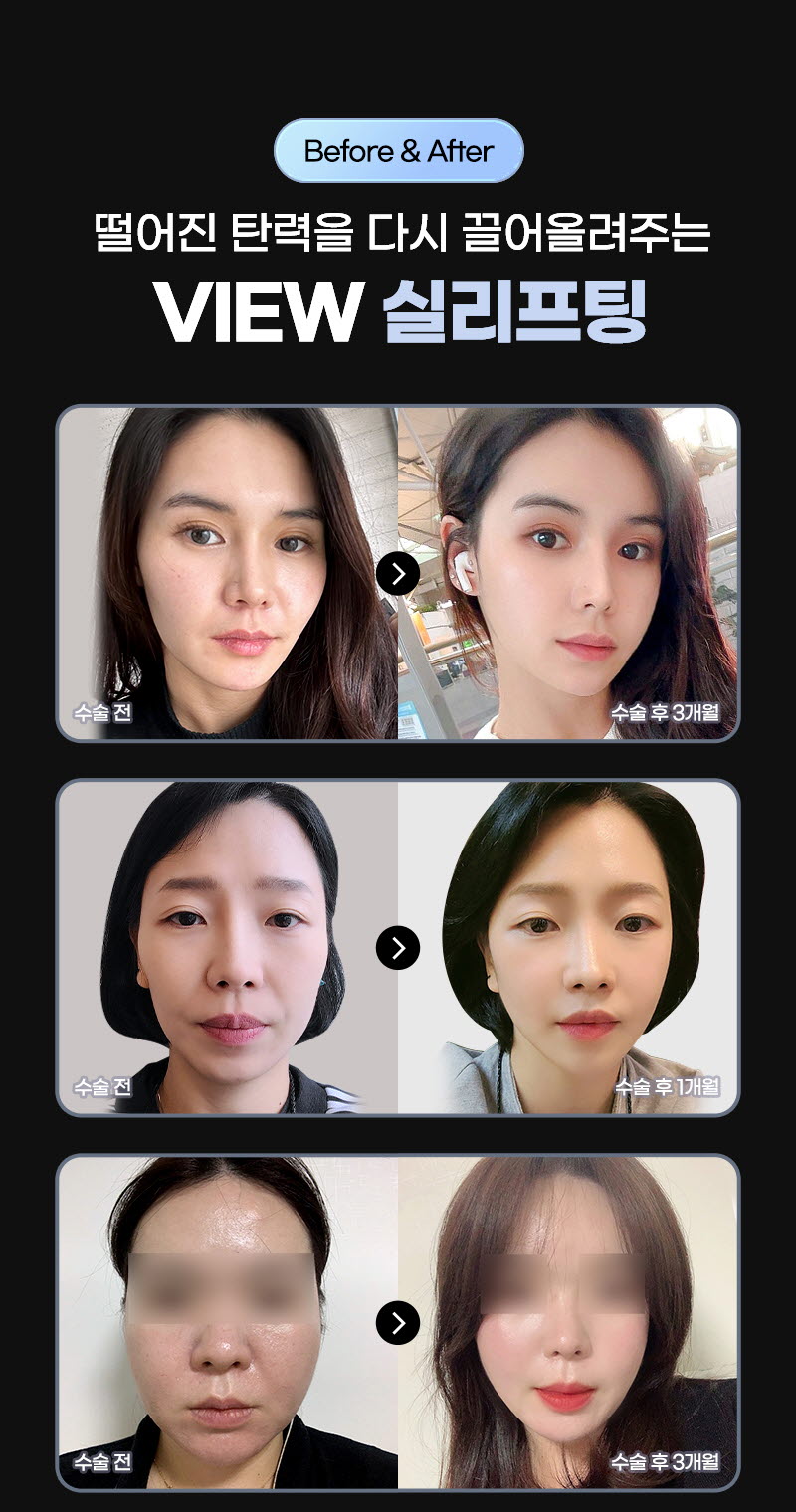 뷰성형외과 ❤뷰❤엘라스티꿈 실리프팅 이벤트, 시술 상세 이미지