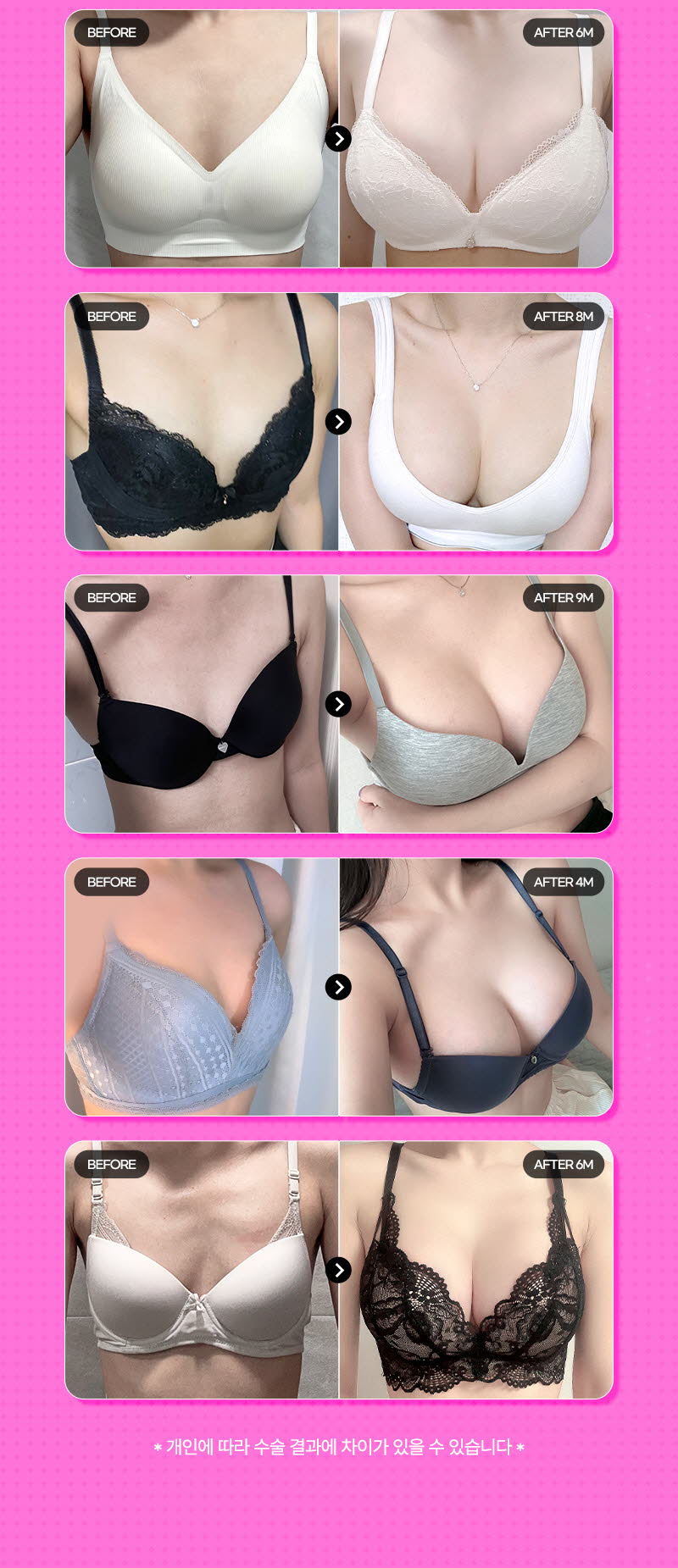 뷰성형외과 ❤️뷰❤️멘토 부스트 이벤트, 시술 상세 이미지