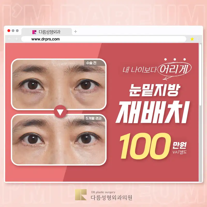 어두운 눈밑은? 다름 눈밑지방재배치