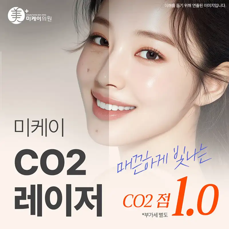  미케이 CO2 레이저_점, 사마귀